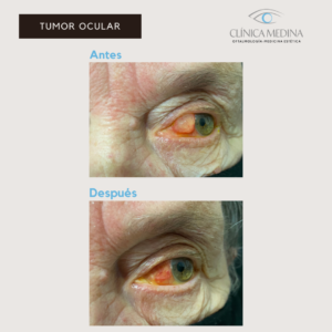 Tumor ocular Clínica Medina Tenerife