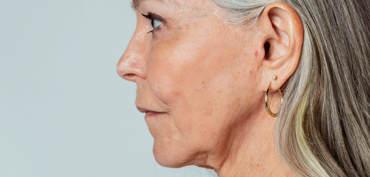 Corrección de lóbulos de oreja rasgados: Lobuloplastia